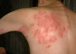 shingles